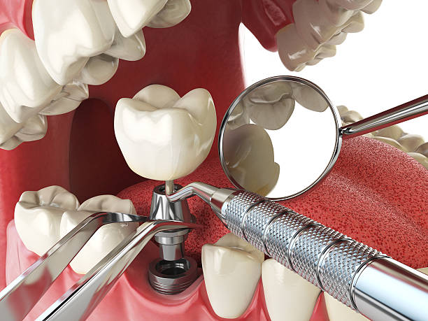 Best Emergency Dental Care for Abscessed Tooth in Welcome, SC